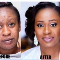 +27710732372 Scars And Stretch Marks Removal Cream In N'dalatando Town in Angola, Pimple Treatment I