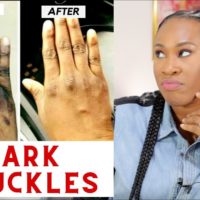 +2771 073 2372 Dark Knuckle And Vitiligo Removal In Same Town in Timor-Leste And Vaasa In Finland